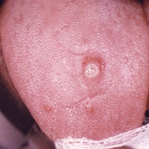 Syphilis chancre symptom on tongue