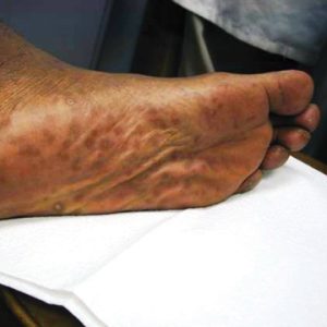 Second stage syphilis chancre on foot