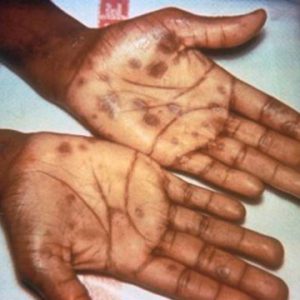 Second stage syphilis chancre on hands