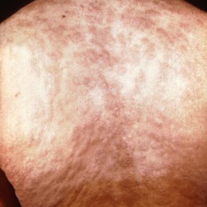 Second stage syphilis chancre on back
